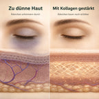 Vergleich: Zu dünne Haut mit durchschimmernden Äderchen vs. mit Kollagen gestärkte Haut